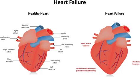 global hypokinesia of lv|left ventricle not pumping properly.